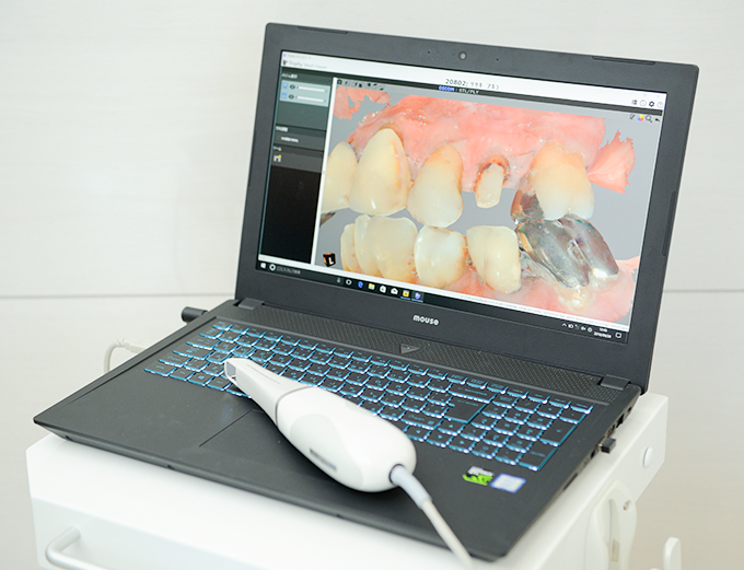 3D光学印象スキャナー